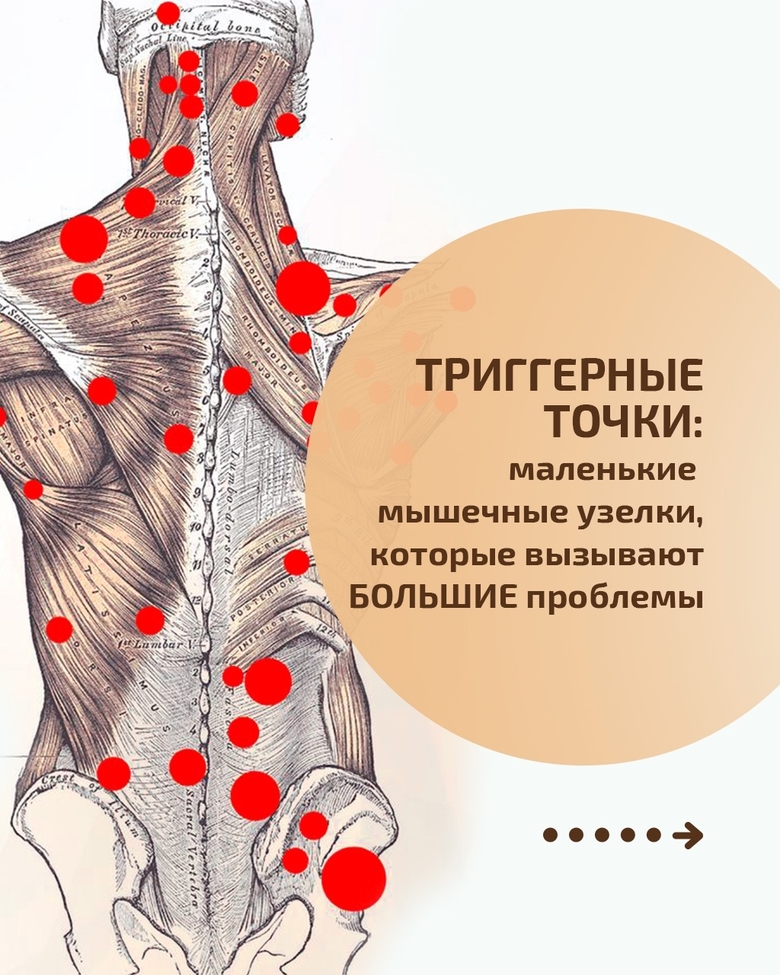 Триггерные точки